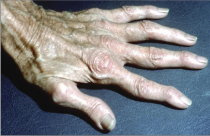 figurE 2. Acrogeria in a 32-year-old woman with EDS  vascular type. The hand looks much older than the patient really is.