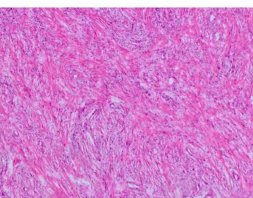 Figure  1.  Photomicrograph  reveals  transecting  spindle  cell  bundles  intermixed  with mononuclear inlammatory iniltrate (HE x100)