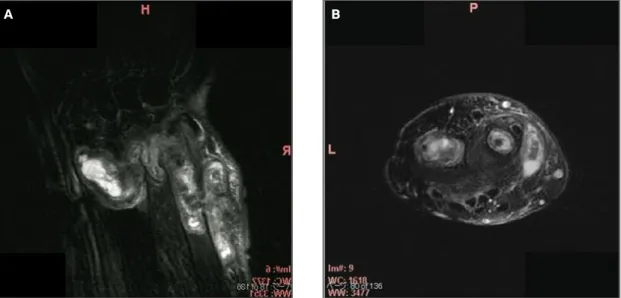 FIGure 2. Preoperative MRI of the right wrist. A) Coronal image with fat-suppression (chemical shift selective method, CHESS).