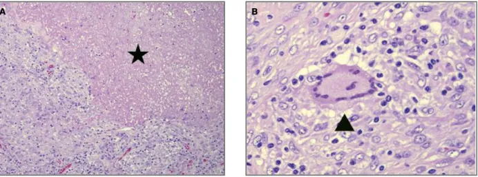 FIGure 3. Histopathologic photograph. A,B) Histological sections stained with hematoxylin and eosin show epithelioid granuloma (arrow head) with caseous necrosis (asterisk), infiltration of inflammatory cells, and fibrosis