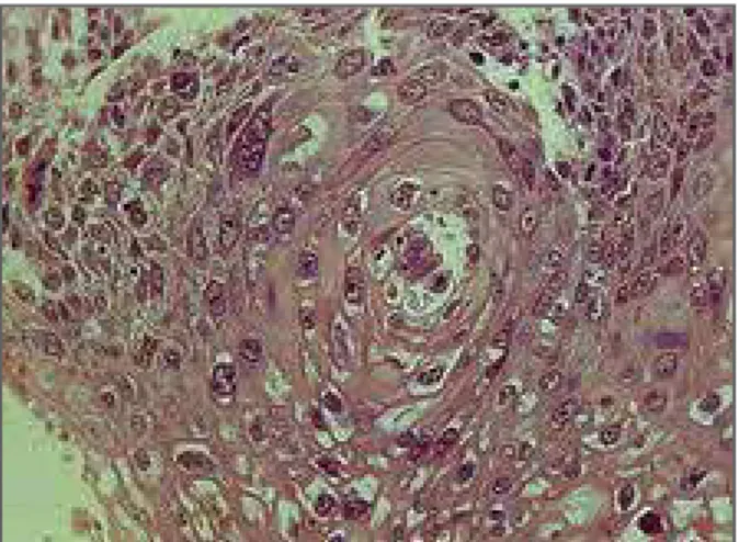 fIgURE 2. Cervical intraepithelial neoplasia (CIN 3) in the cervix  