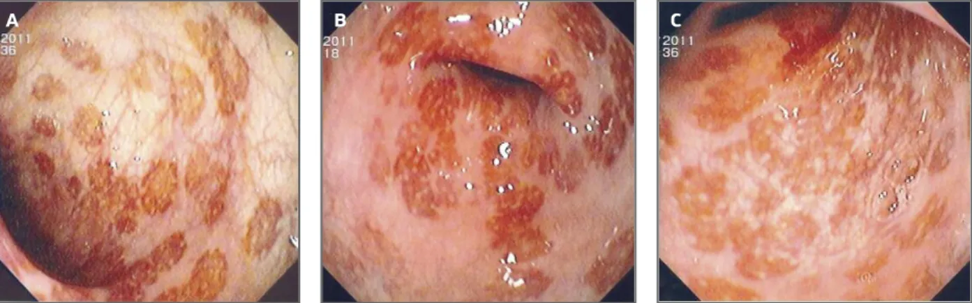 FIGure 1. Aspects of the colonic mucosa in rectossigmoidoscopy: focalized and irregular areas with hyperemia and superficial erosions, surrounded by areas of normal mucosa 