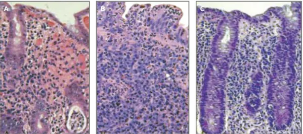 FIGure 2. Pathologic examination of the biopsies of colonic mucosa showing hemorrhagic foci, crypt abscesses, lymphoplasmacytic and neutrophilic inflammatory infiltrate of the lamina propria, with mild distortion of the architecture 