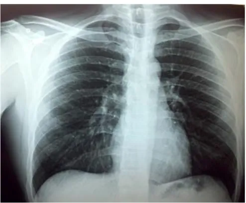 Figura 2. Radiografia do tórax mostrando normalidade da imagem. 
