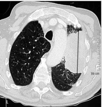 FIGure 1. Thoracic CT scan showing an infiltrating mass, 10 cm of major diameter, with ipsilateral mediastinal metastatic lymph nodes