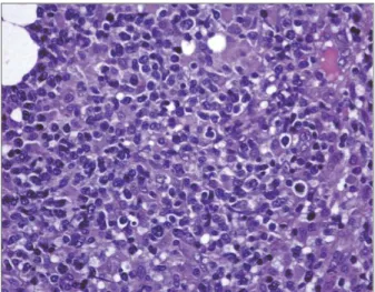 FIGUrE 3a. Hematoxylin and eosin colouration showing  lymphoproliferative disorder suggestive of NK/T nasal type