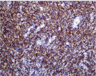 FIGUrE 3d. Immunocytochemical study without unequivocal CD56 (NCAM) demonstration