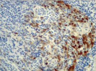 FIGure 1. H &amp; E (400x): Biopsy of colon showing diffuse  proliferation of small/medium-sized lymphoid cells