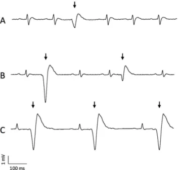 Fig 1. ECG recordings illustrating ectopic beats (arrows) in 3 different WAR studied at 1 year of age.