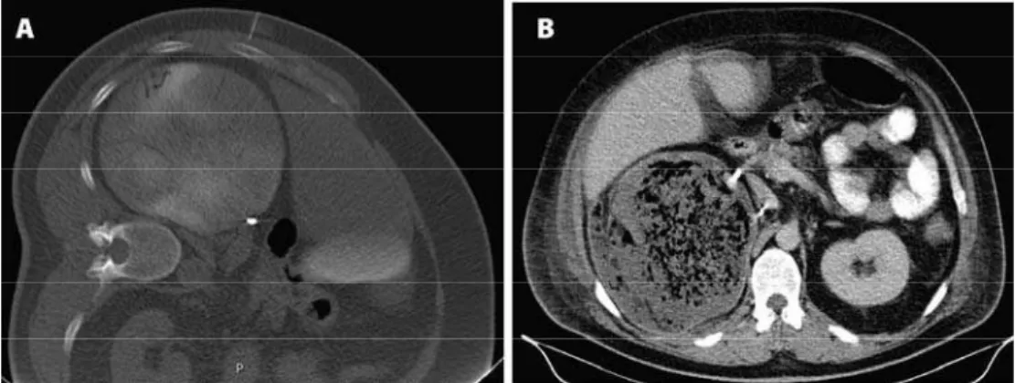 Figure 5 shows renal tumor immediately after embolizati- embolizati-on and a few days after embolizatiembolizati-on with air development