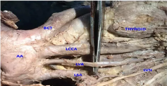 Fig. 2:  Show ing Anom alous Left  vert ebral art ery.