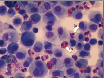 FIGuRA 3. Exame do lavado broncoalveolar em detalhe  microscópico, apresentando numerosos neutrófilos (a) e  eosinófilos (b)