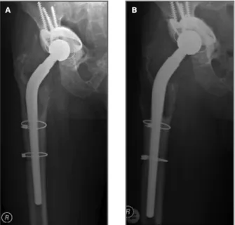 FIGurE 2. Five months later, painful and severe expansive  osteolytic lesion of the proximal femur
