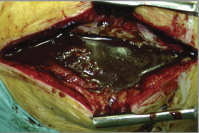 FIGurE 3. Intraoperative photograph showing a large amount of a brownish fluid under great pressure (400 cc) in the  pseudojoint cavity and in the joint space
