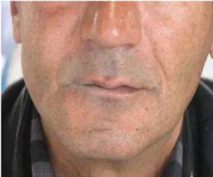 Fig 1. Swelling on the right side of the face. 