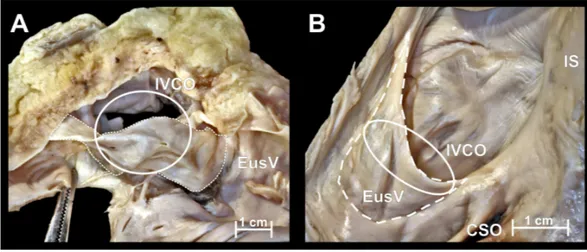 Figure 1 Photographs of cadaveric heart specimen. View of the inferior vena cava ostium (IVCO) with present Eustachian valve (EusV).
