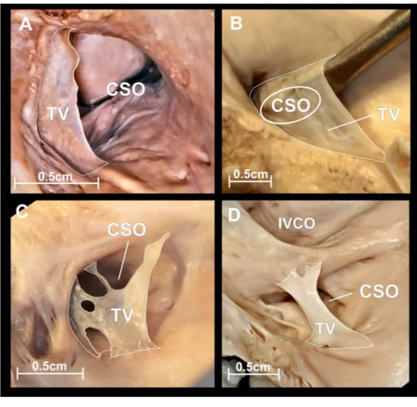 Figure 3 Thebesian valve. Photographs of cadaveric heart specimens. View of the coronary sinus ostium (CSO) with present Thebesian valve