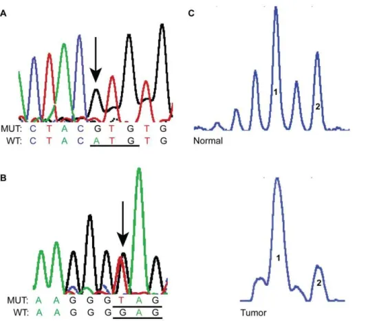 Figure 1. Representative SGN samples showing TP53 missense mutations (A and B) and LOH (C) using the microsatellite marker TP53 located on chromosome 17 p