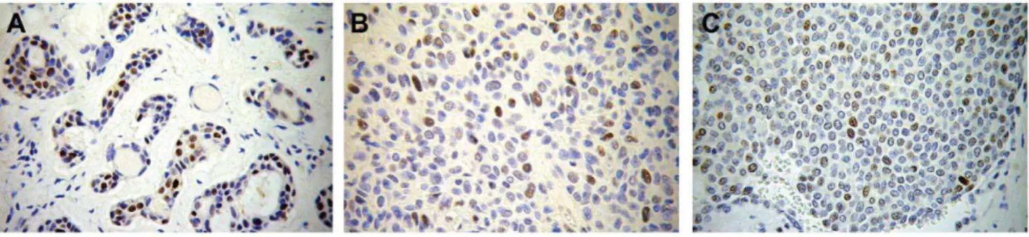 Figure 3. Immunohistochemistry photomicrographs showing p53 expression in three positive samples