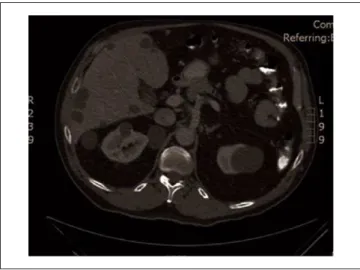 Figure 2.  CT abdomen/pelvis with contrast obtained for  evaluation of hypercortisolism
