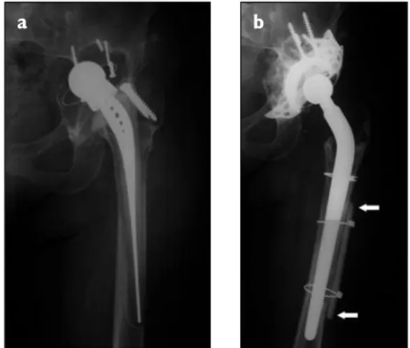 Figure 2 a) and b). Surgical treatment of an aseptic loosening of a total prosthesis using a cementless femoral stem revision and a cortical onlay strut allografting  (arrows), with 5 years of follow-up