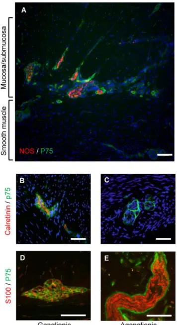 Fig 1. Expression of neural markers in colonic biopsies from Hirschsprung patients. A) Full thickness frozen section of aganglionic Hirschsprung bowel showing thickened nerve trunks immunolabeled for the neural crest cell marker p75 (green) and neuronal NO