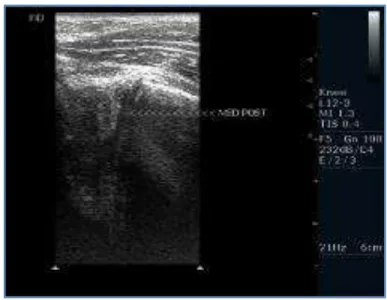 Fig.  1:  28  years  old  male  with  traumatic  injury  to  the  knee  underwent  USG,  MRI  and  arthroscopy