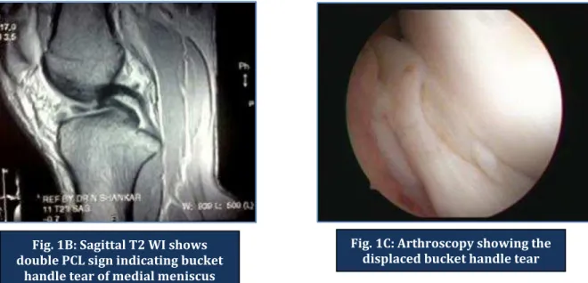 Fig. 2: 22 yr old male underwent USG, MRI and arthroscopy following injury 