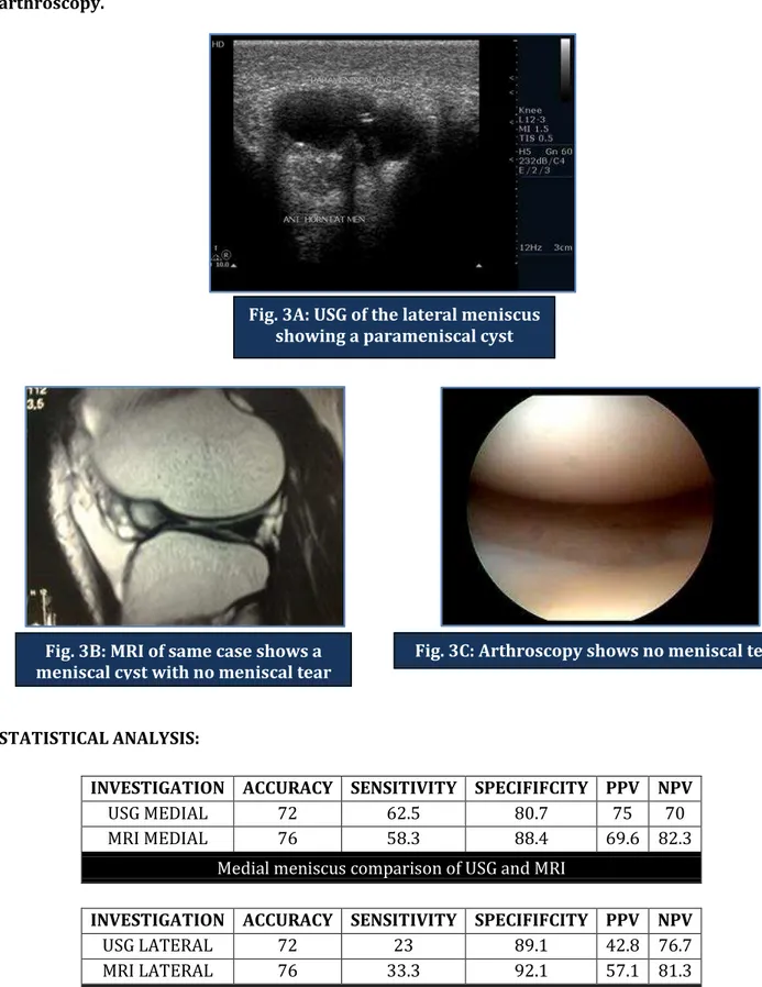 Fig. 3B: MRI of same case shows a  meniscal cyst with no meniscal tear 