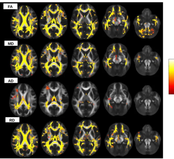 Figure 3. Differences in DTI measures between patients and controls. Statistical maps showing voxels which exhibit differences in DTI parameters in patients versus controls (red and yellow colours, according to the lower and higher significance, respective