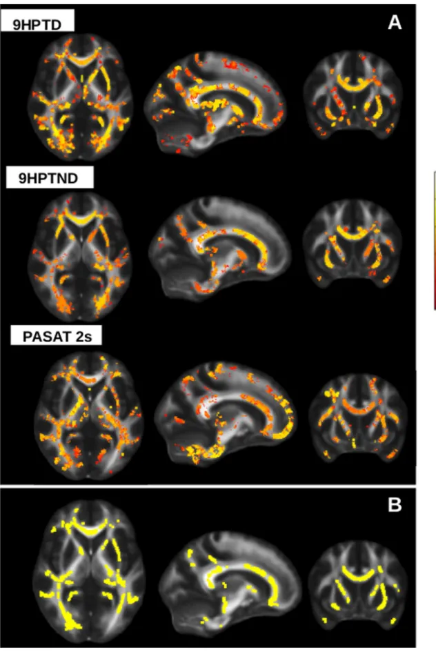 Figure 4. Correlation between FA in patients and MSFC subscales. Statistical map showing voxels which correlate with clinical scores