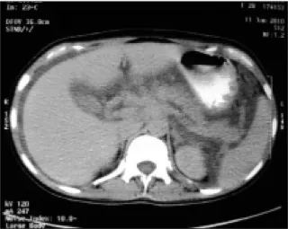 Figura 2. Caso 2 Tomografia abdominal no primeiro dia dos sintomas, com aumento volumétrico do pâncreas.