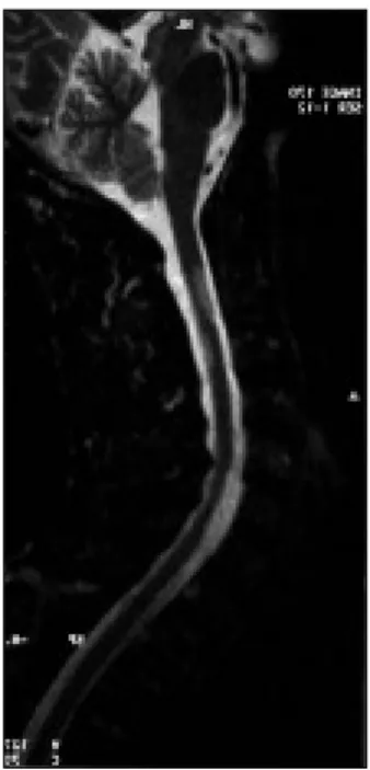 Figura 2. RMN Medula Espinhal: múltiplas lesões desmielinizantes ao longo da medula cervical