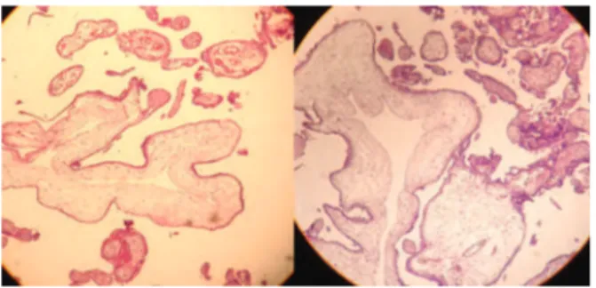 Fig 2: Pathology of partly molar change associated with a  normal fetus in family (S)