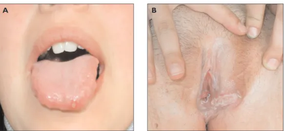 Figura 1. Caso clínico 1: Ulceração oral (Figura 1A) e genital (Figura 1B) antes do início de  tratamento com infliximab.