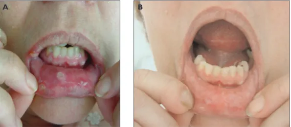 Figura 4. Caso clínico 3: Figura 4A: Ulceração oral exuberante antes do início da terapêutica biológica.
