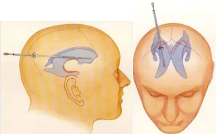 Figure 2. Lateral ventricles puncture 