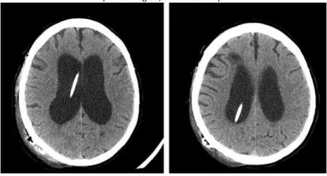 Figure 3. The ventricular catheter placed inside the right lateral ventricle and the selfregulating valve placed in the right  parietal region, under the scalp