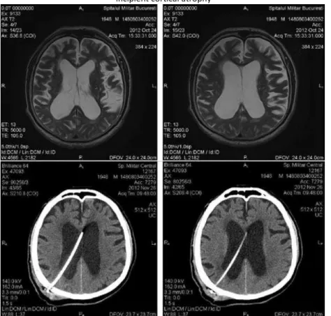 Figure 6. Preoperative MRI (T2 sequence) and postoperative CT scan; right ventricular catheter;prominent convexity sulci; 