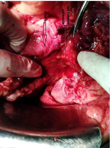 Figure 2 : shows large spleenic aneurysm  communicating with colon. 
