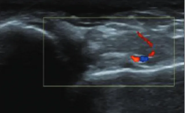 Figura 4. Recesso medial da articulação tibiotársica  direita com sinal doppler grau 2.
