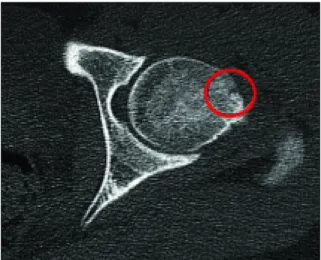 Figura 3. Imagem de TC: visão axial de TC em que se identifica o nidus calcificado (círculo), que se traduz pela presença de lucência com área central esclerótica na  dependência da cortical da transição da vertente anterior do colo para a cabeça femoral.A