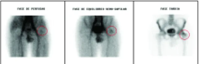 Figura 5. Cintilograma ósseo em 3 fases da bacia com administração endovenosa de HDP-99mTc