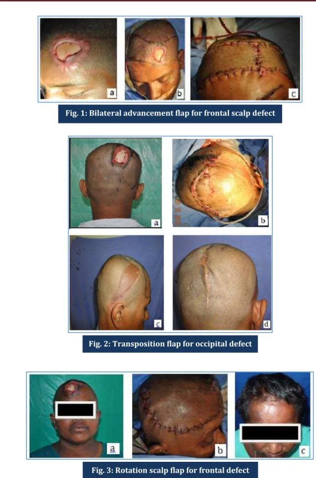 Fig. 1: Bilateral advancement flap for frontal scalp defect