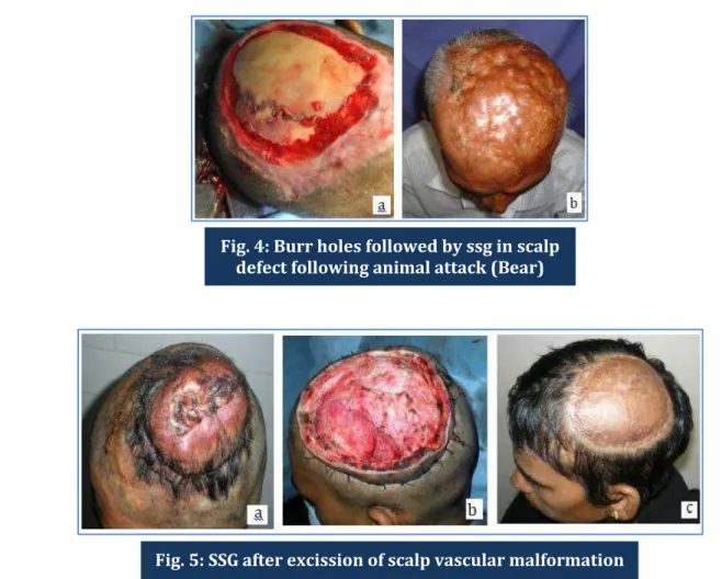 Fig. 5: SSG after excission of scalp vascular malformation
