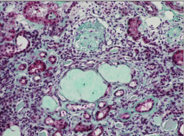 Figure 4. Two hyaline glomeruli and peritubular sclerosis with epithelial atrophy (Masson tricromic staining;