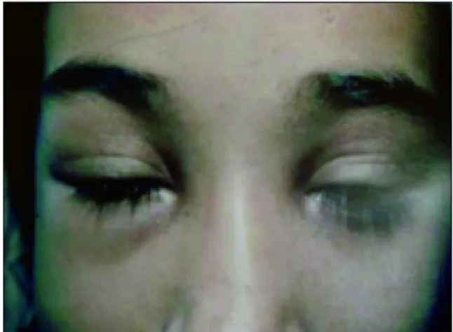 Figura 2. Edema palpebral e heliótropo.