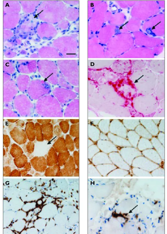 Figure 1. Histological examination of muscle biopsies from patients with inclusion body myositis reveals abnormalities  of varying severity