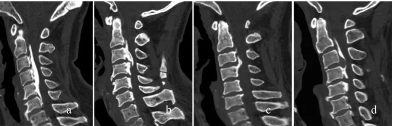 Fig 2. Morphological types of OPLL were classified into the continuous type (a), segmental type (b), circumscribed type (c) and mixed type (d) according to Hirabayashi's classification.