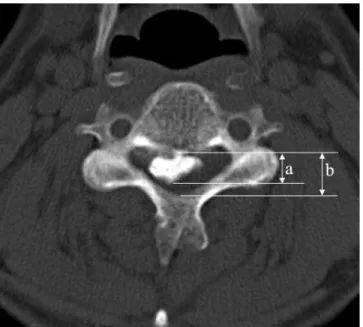 Fig 4. The occupying ratio of the spinal canal was defined as the ratio of the maximal ossification thickness (a) to the anterioposterior spinal canal diameter (b) on CT axial imaging.